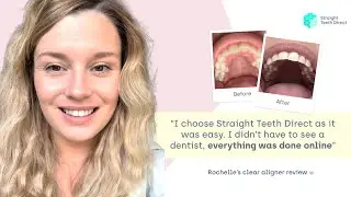 Rochelle&rsquo;s review | Remote clear aligners experience 🦷