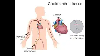 Heart catheterization or cardiac catheterization or cardiac cath