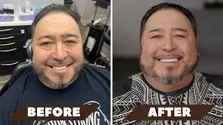 Same Day Smile with 3-on-6 Dental Implants | Teeth in a Day | Chicago Implant Dentist