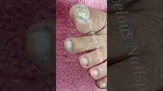 Видеоурок по педикюру с удалением вросших волос