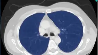 Real-time CT lungs segmentation online with deep learning