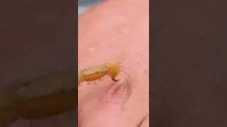 Ужалил ядовитый скорпион. Что делать?
