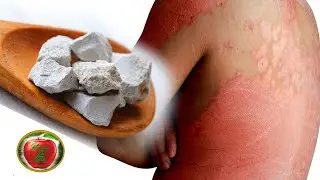 What to do in case of radiation or burn - Important to know !