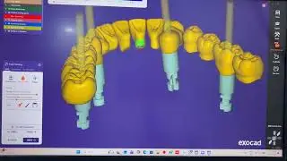 ExoCAD Multi Unit Bridge Design | All-on-4 Workflow with NewDent Implant System