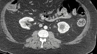 Foley balloon in urethra