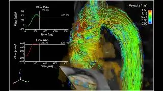 Aortic 4D flow MRI   3D blood flow in a patient with a bicuspid aortic valve osgSmEMGSyk