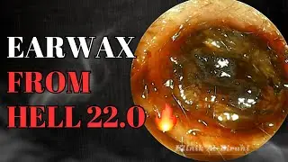 Earwax From Hell 22.0🔥‼️