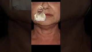 Wrinkled Neck Treatment