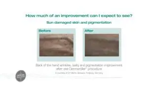Genuine Dermaroller at Zenith Cosmetic Clinics