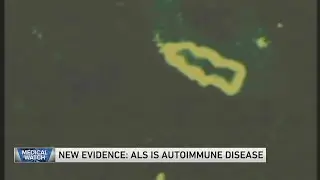 New evidence: ALS is autoimmune disease