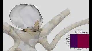 ICAD 2021 - Aneurisk case 0032 sonified visualization
