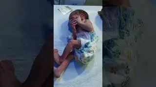 newborn baby abdomen pain 😔#newborn#baby#abdominal#pain#viral#video#@