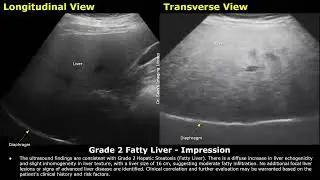 Grade 2 Fatty Liver Ultrasound Report Example | Diffuse Hepatic Steatosis Sonography | Abdominal USG
