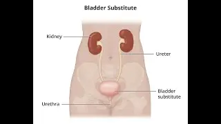 Anastomosis of single ureter to bladder CPT code - simplify medical coding