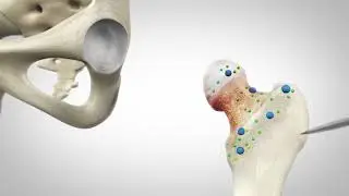 THA- Stryker Mako Total Hip Animation