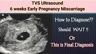 6wks Early Pregnancy Miscarriage | Missed Abortion