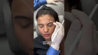 T&eacute;cnica de botox para arqueamento de sobrancelha