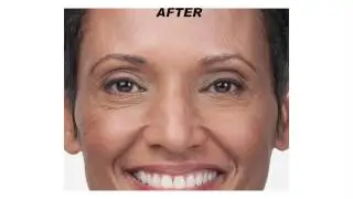 The Benefits of Botox - Western Dermatology ABQ