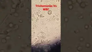 #trichomonas and #wbc