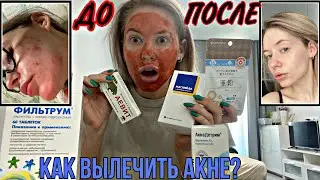 АКНЕ / ЛУЧШИЕ ВИТАМИНЫ / ИСТОРИИ ИЗ ЖИЗНИ