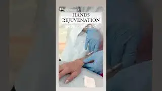 Revitalize Your Hands with Fillers: Hands Rejuvenation Treatment by Dr. Farshad
