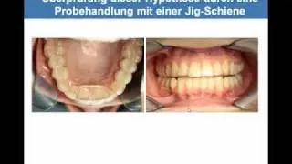 Theorie der Krafteinleitung Jig-Schiene.mp4