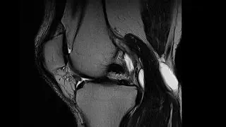 Human MRI (Magnetic Resonance Imaging) Sequences, Right Knee V16936