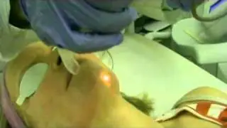 MicrolaserPeel by Dr. Yuriy Yagudin.avi
