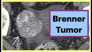 Brenner Tumor #obgyn #radiology #gynecology