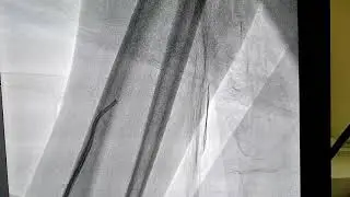 Radial artery loop