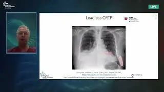 Presentation, Discussion & Event Wrap-up: Future of Leadless CRT Pacing
