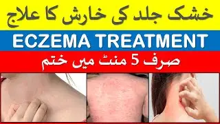Dry Skin Itching Problem Treatment - Home Remedy for Face Patches Peeling and Seasonal Eczema