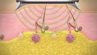 miraDry Me -  How underarm sweat treatment works