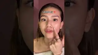 HOW TO GET RID OF ACNE FAST 😩