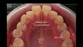 Digital Smile Design In Orthodontics