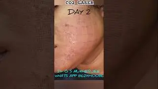 CO2 LASER DAY BY DAY #co2laser #acnescar #drgsmukherjee #acnescartreatment #dermatologist