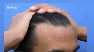 Hair Transplant Video - Dr Hasson - 3200 Grafts - 2 Sessions