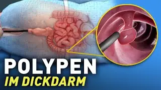 Entfernung von Polypen aus dem Dickdarm verstehen! (Polypektomie)
