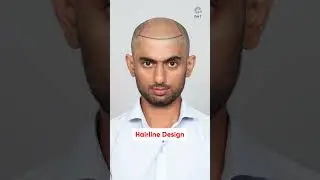 Nine Months Hair Transplant Results | Latest Fue Technique #shorts #viral #hair transplant