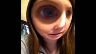 My busted eye