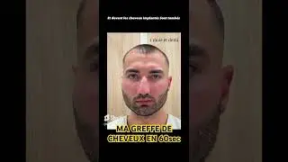 &Eacute;volution greffe de cheveux sur 1 an #greffedecheveux #dhi #hairtransformation #hairtransplant #hair