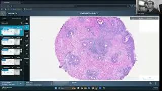 Simple Pathology of Female Pattern Hair Loss (Androgenetic Alopecia) and a Zit (Acneiform lesion)