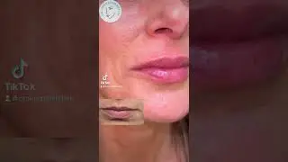 Natural Lip Filler!