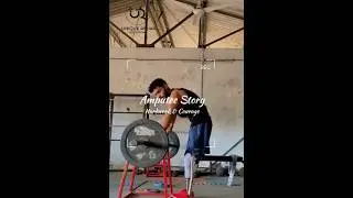 🦿Bilateral Above knee amputee NO stopping👍 Nakli Tang #ossur #prosthetics #artificiallimb