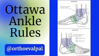 Ottawa Ankle Rules-