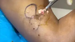 Multiple Lipoma (लिपोमा) Live 24 hour Result #lipoma #lipomatreatment #lumps #cyst #skincare