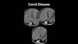 Caroli Disease- Rare Genetic Disorder(Radiology Spotters) #neet #neetpg #radiology#doctor #medicine