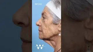 Before and after results: Upper and Lower Blepharoplasty (Eyelid Lift) and a Deep Plane Facelift