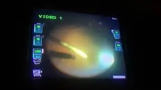 Vitrectomy for LMH in DIABETIC RETINOPATHY BY DR AJAY DUDANI