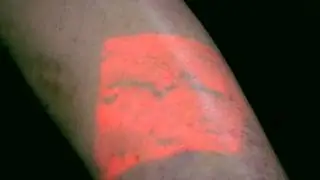 AccuVein for Vascular Surgery